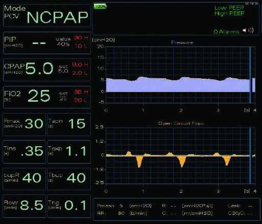 1. GIULIA_Neonatal Ventilator_en 2 1. GIULIA_Neonatal Ventilator_en 2