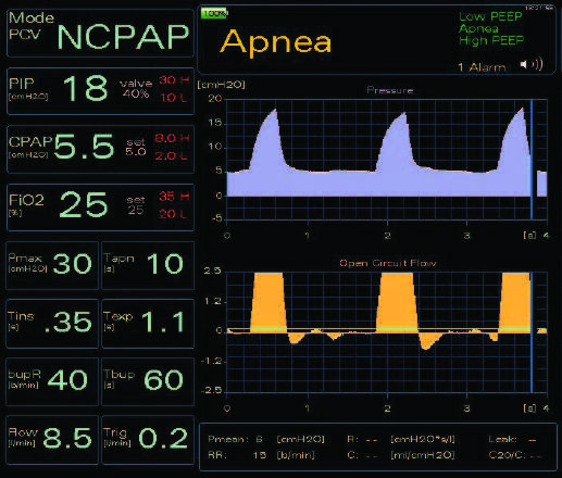 1. GIULIA_Neonatal Ventilator_en 3 1. GIULIA_Neonatal Ventilator_en 3